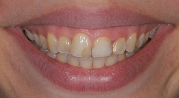 Reinvent Your Teeth With A Smile Makeover